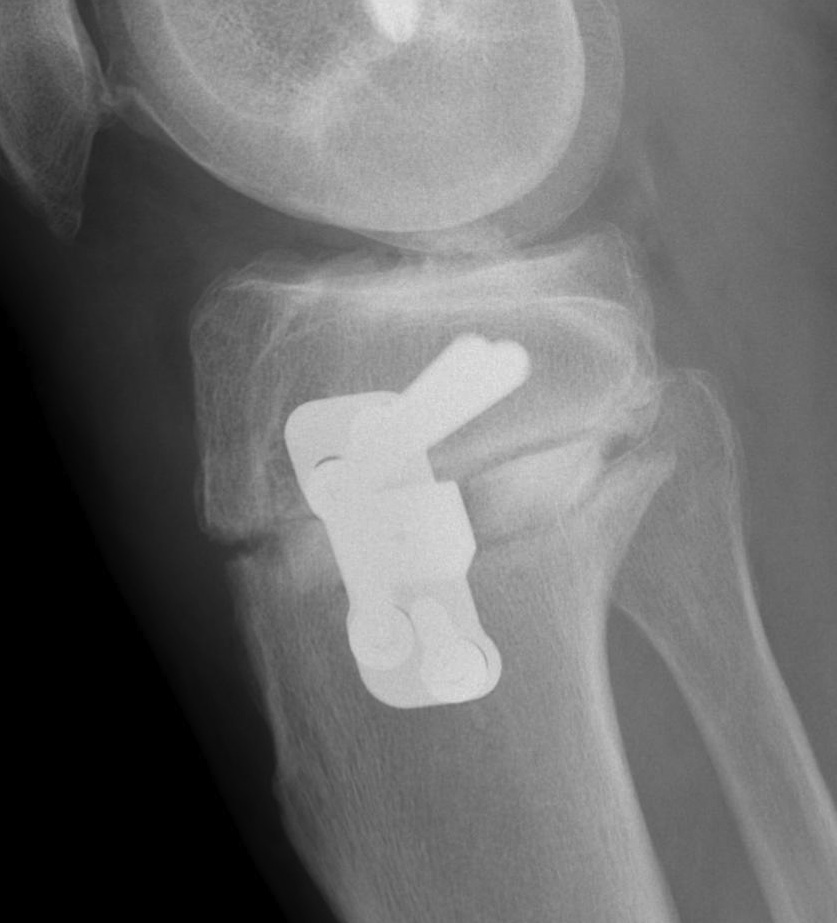 HTO Lateral Xray